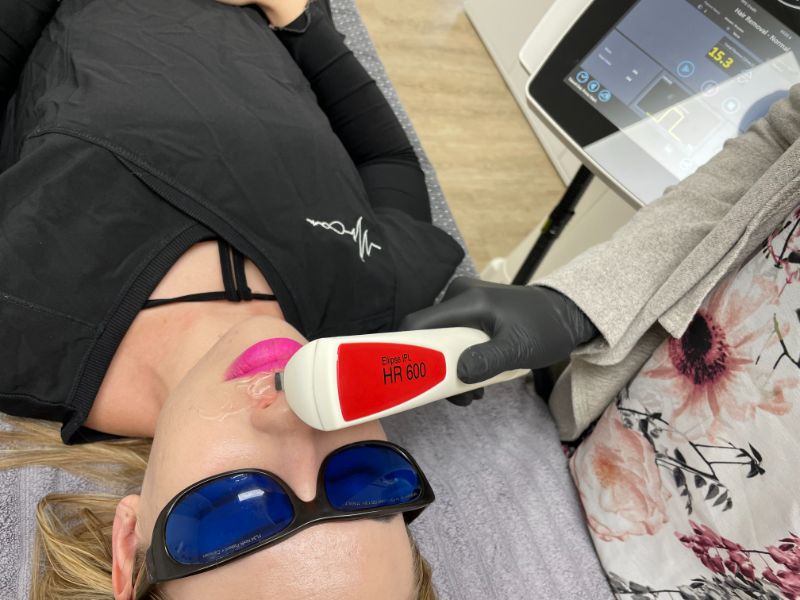 laser-hair-removal-cape-town-removal-on-upper-lip-min