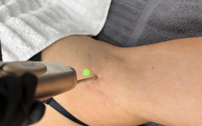 laser-clinic-cape-town-hair-removal-centurion-leg-min