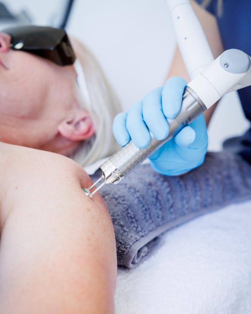 laser-clinic-centurion-shoulder-min