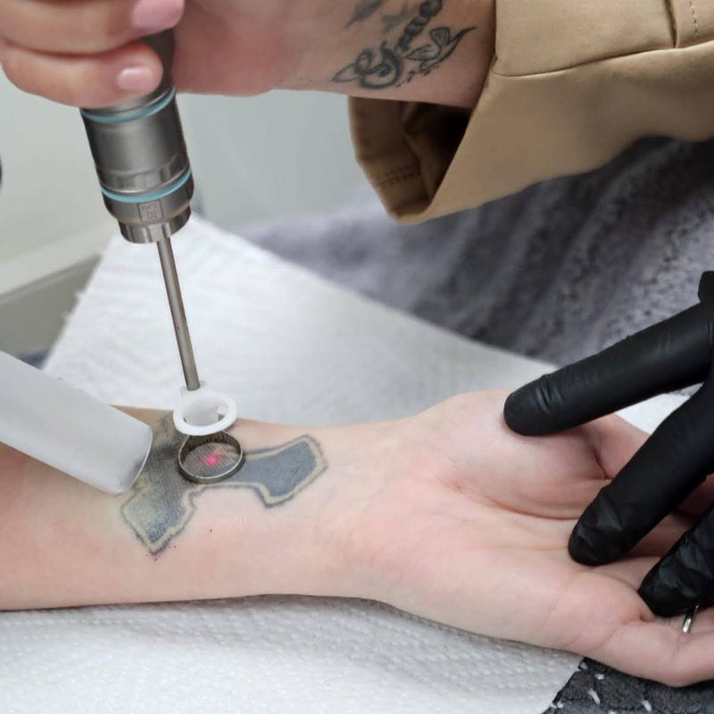 laser-clinic-cape-town-tattoo