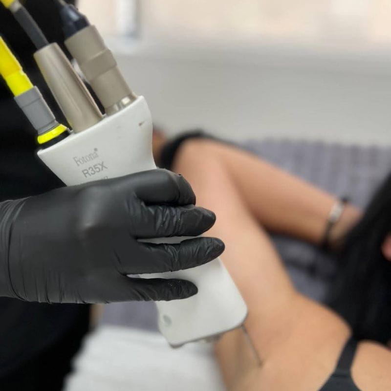 laser-hair-removal-centurion-underarm