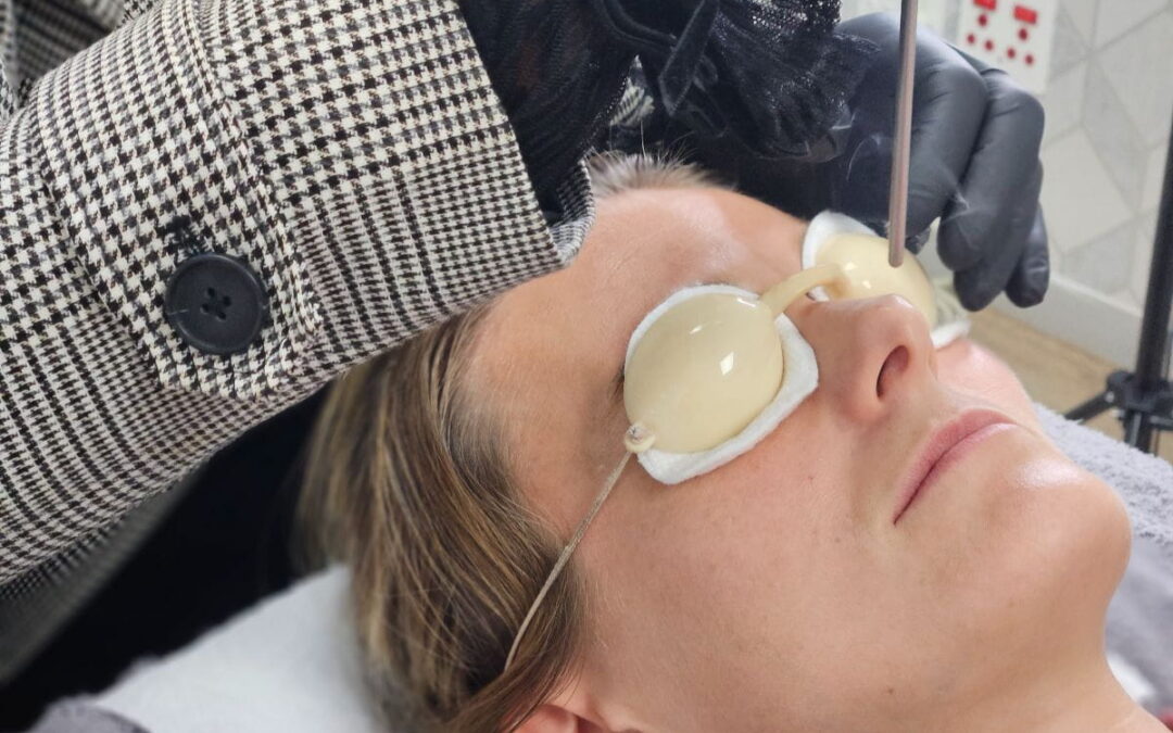 The 12 Week Countdown Plan: Laser Treatment For Face Care Before A Big Event