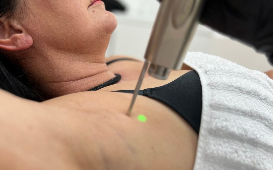 Laser For Hair Removal: The Painless Option