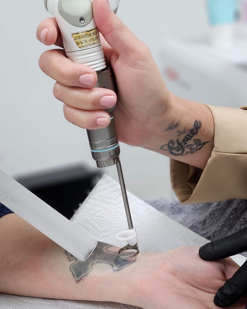 laser-clinic-cape-town-removing-tattoos (1)