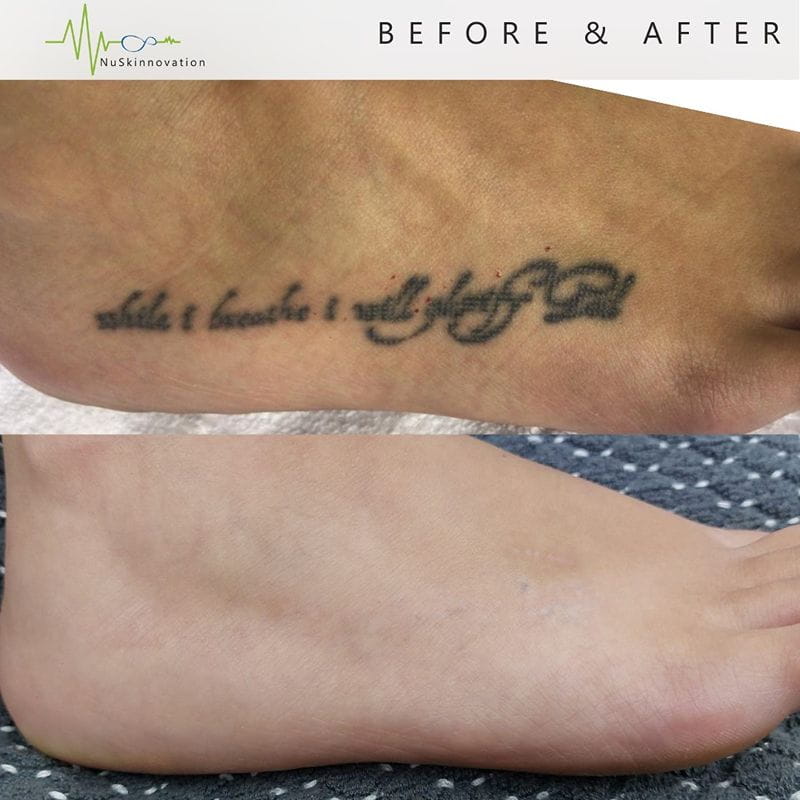 laser-clinic-cape-town-tattoo-removal-before-and-after (1)