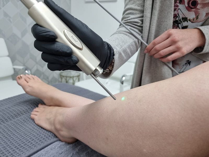 laser-for-hair-removal-on-the-legs (1)